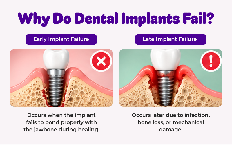 Why Do Dental Implants Fail?