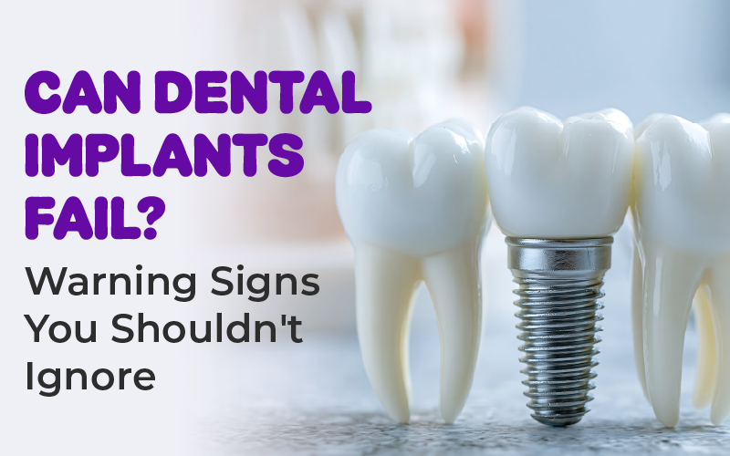 Can Dental Implants Fail? Warning Signs You Shouldn't Ignore
