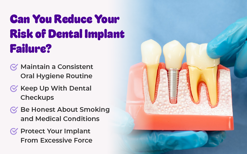 Can You Reduce Your Risk of Dental Implant Failure?