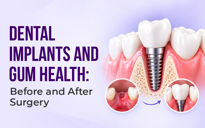 Dental Implants and Gum Health: Why Healthy Gums Matter Before and After an Implant?
