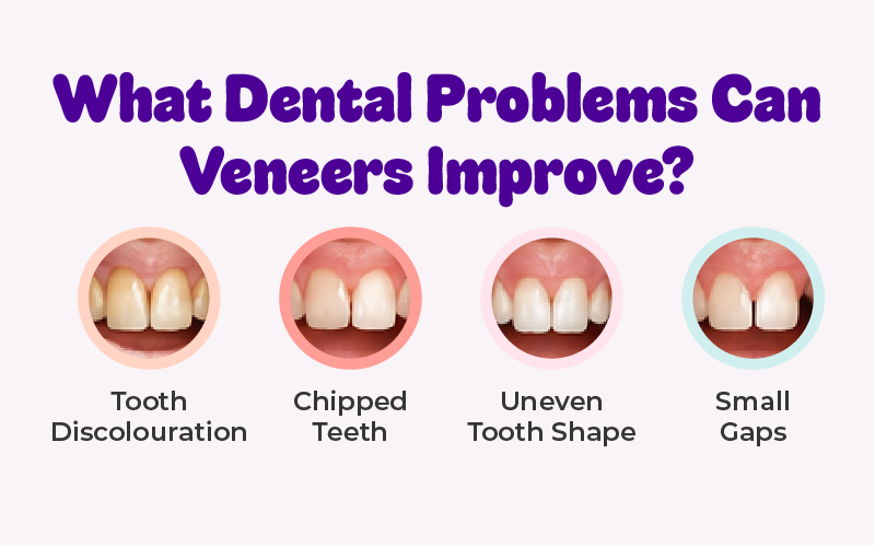 What Dental Problems Can Veneers Improve?