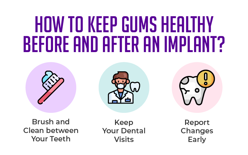 How to Keep Gums Healthy Before and After an Implant