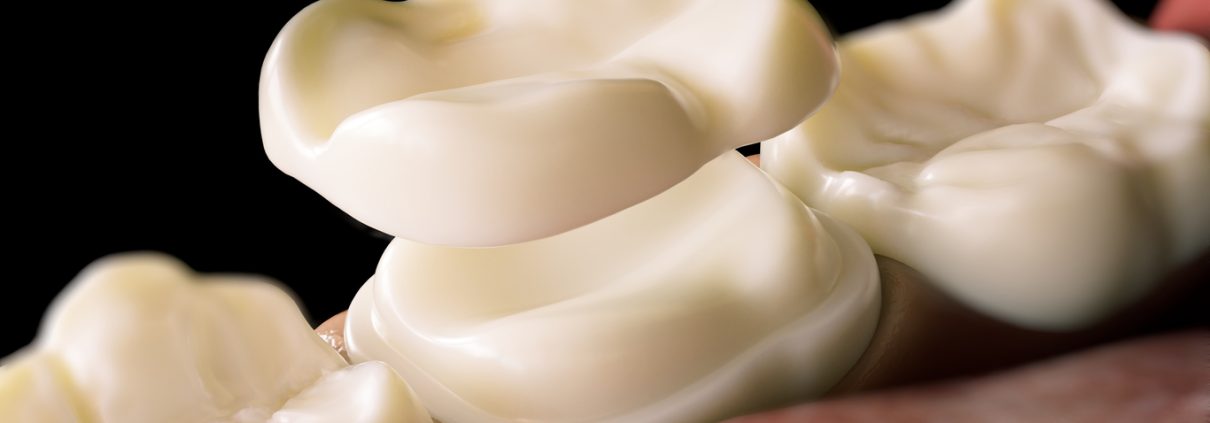 Ceramic Overlay crown over a tooth- 3D Rendering