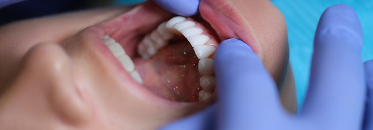 Oral Cancer Screening